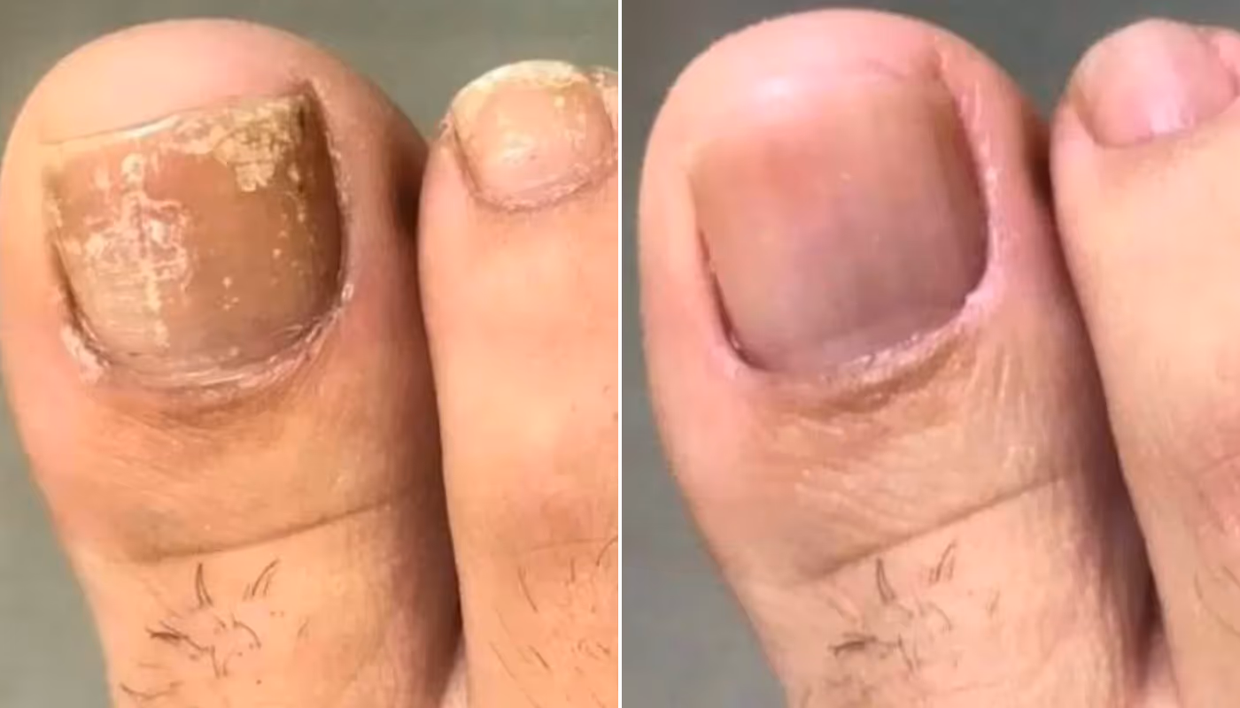 before vs after using orville pen