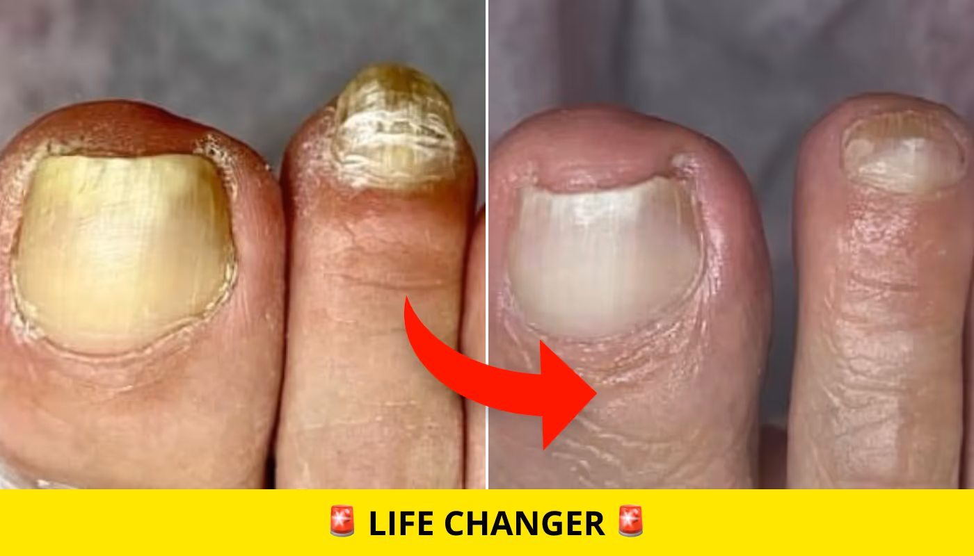 eliminate nail fungus